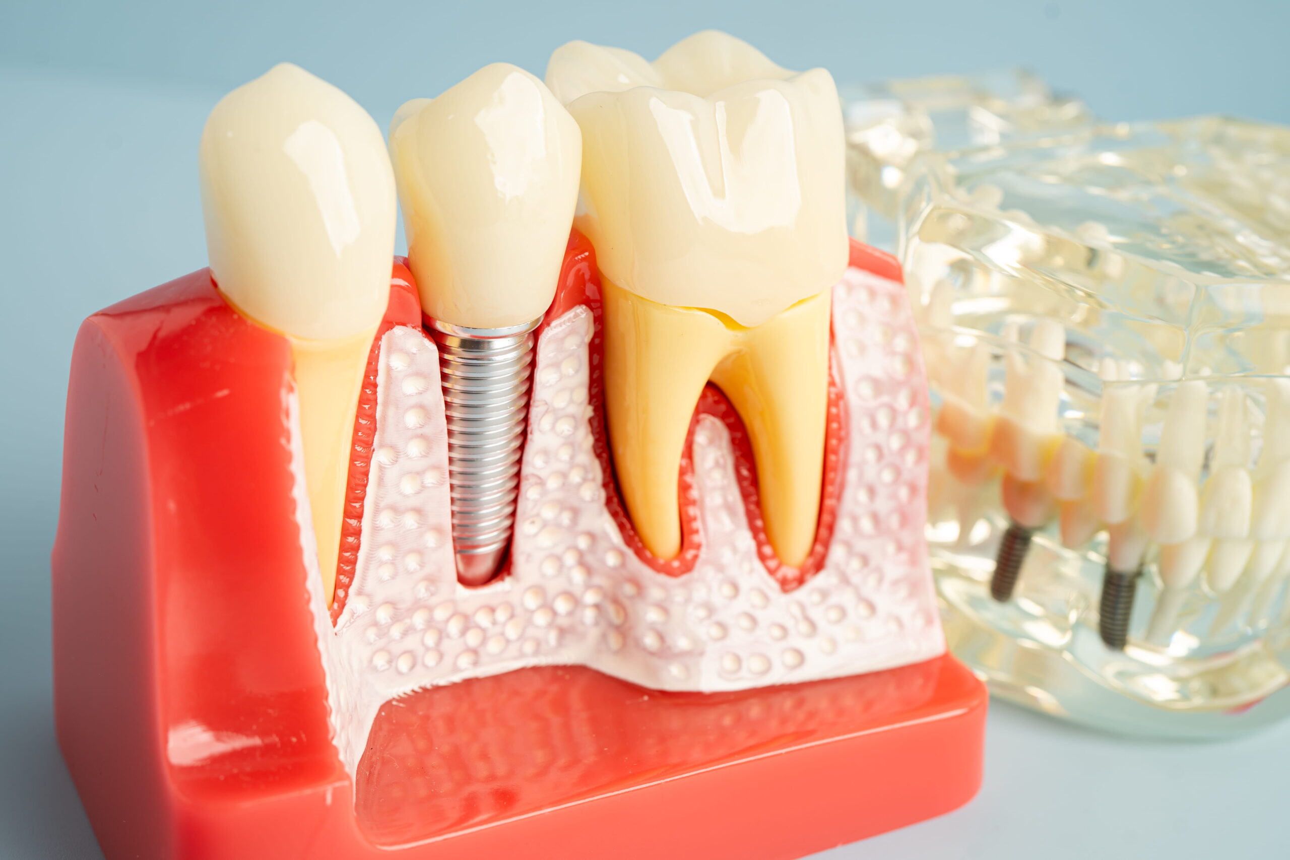 Bone Grafting for Dental Implants