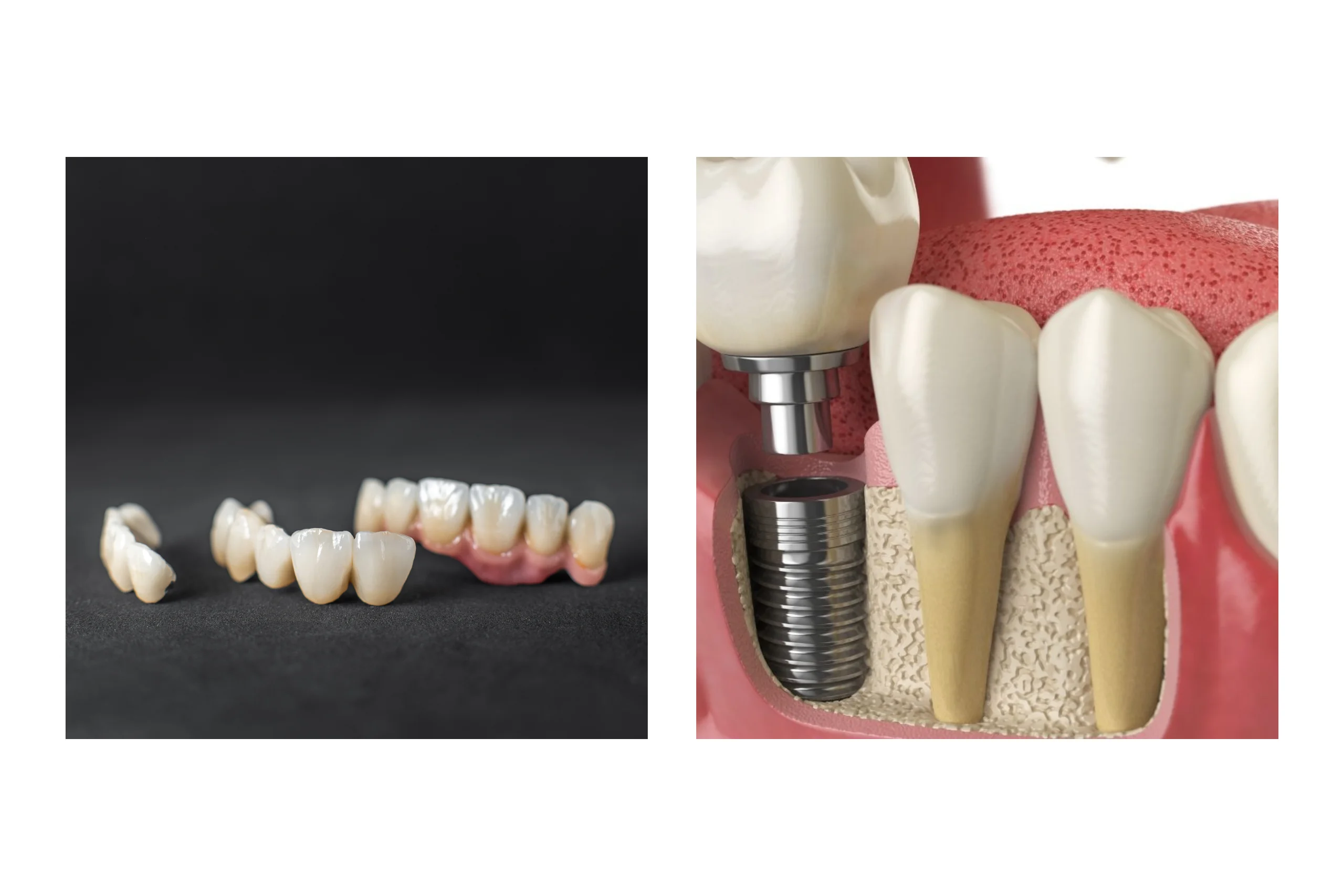 dental Implant vs Bridge